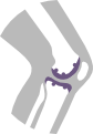 Léčba bolesti kolene - osteoartróza